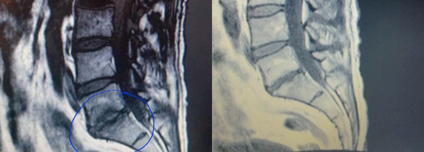 Disc-Regeneration Disc-Regeneration